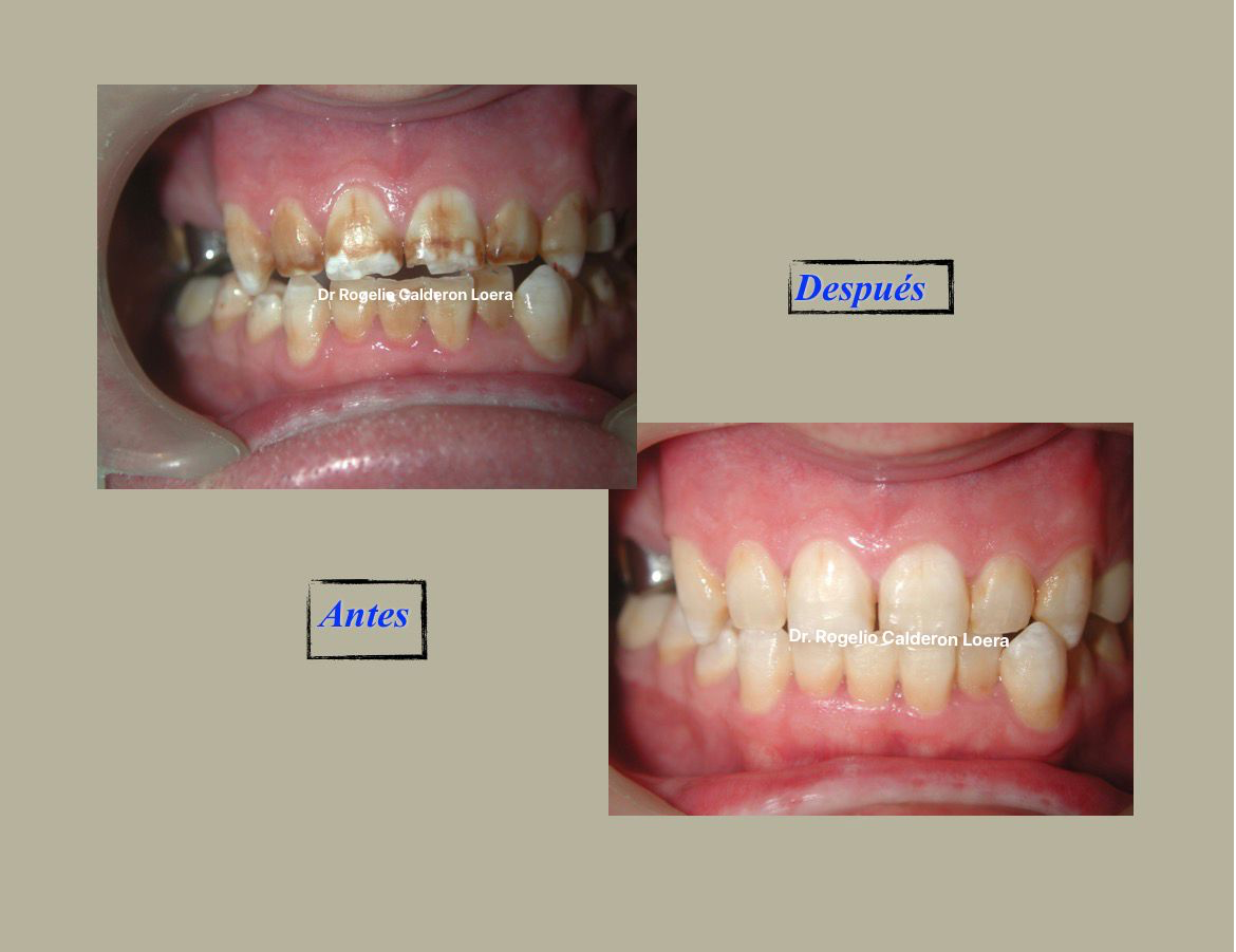 Antes y después dental Dr. Rogelio Calderón